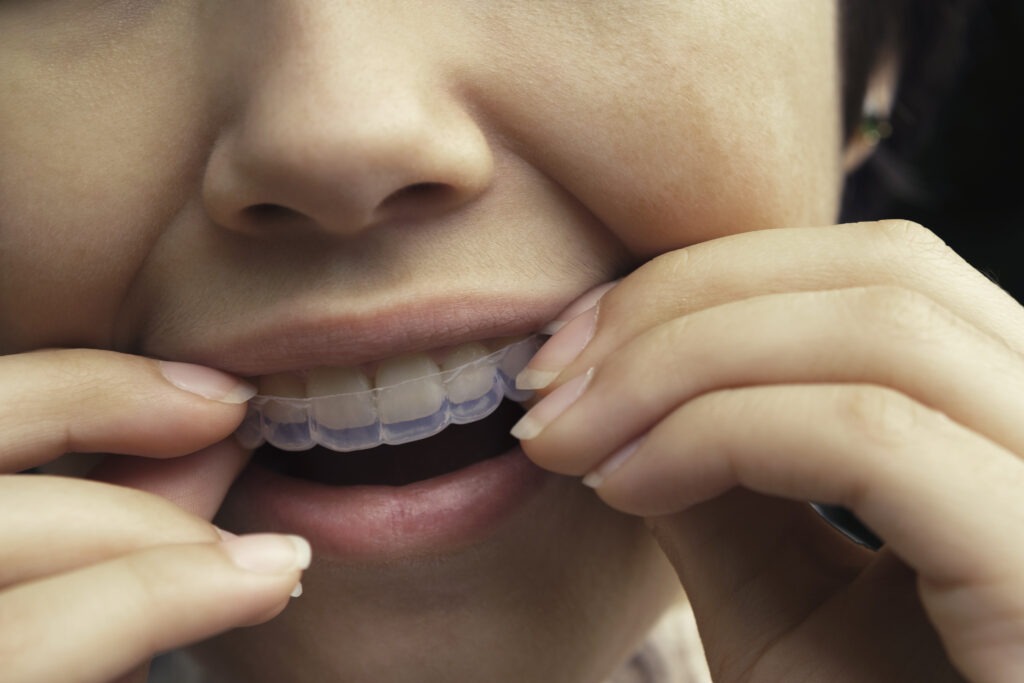 Considering Invisalign for your child? Or maybe they already have it? You're probably questioning what back to school with Invisalign looks like.