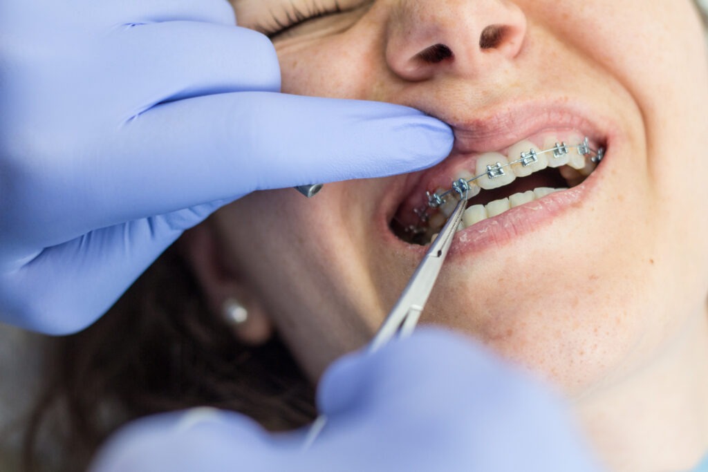 What to Expect When You Get Braces