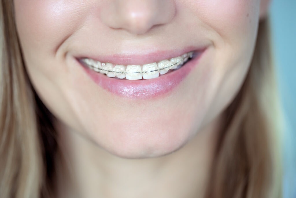 Am I Too Old For Braces?