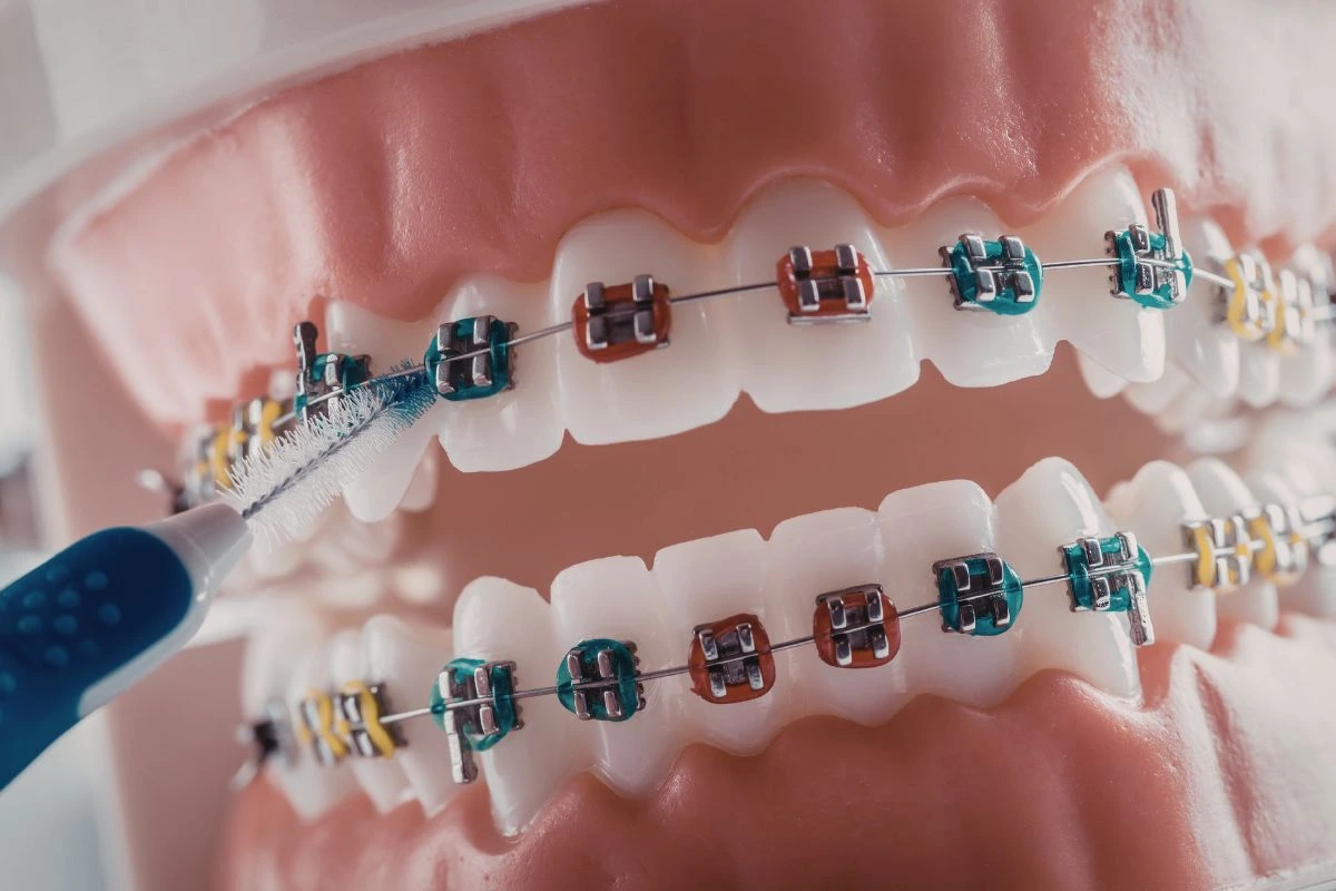 Braces at School