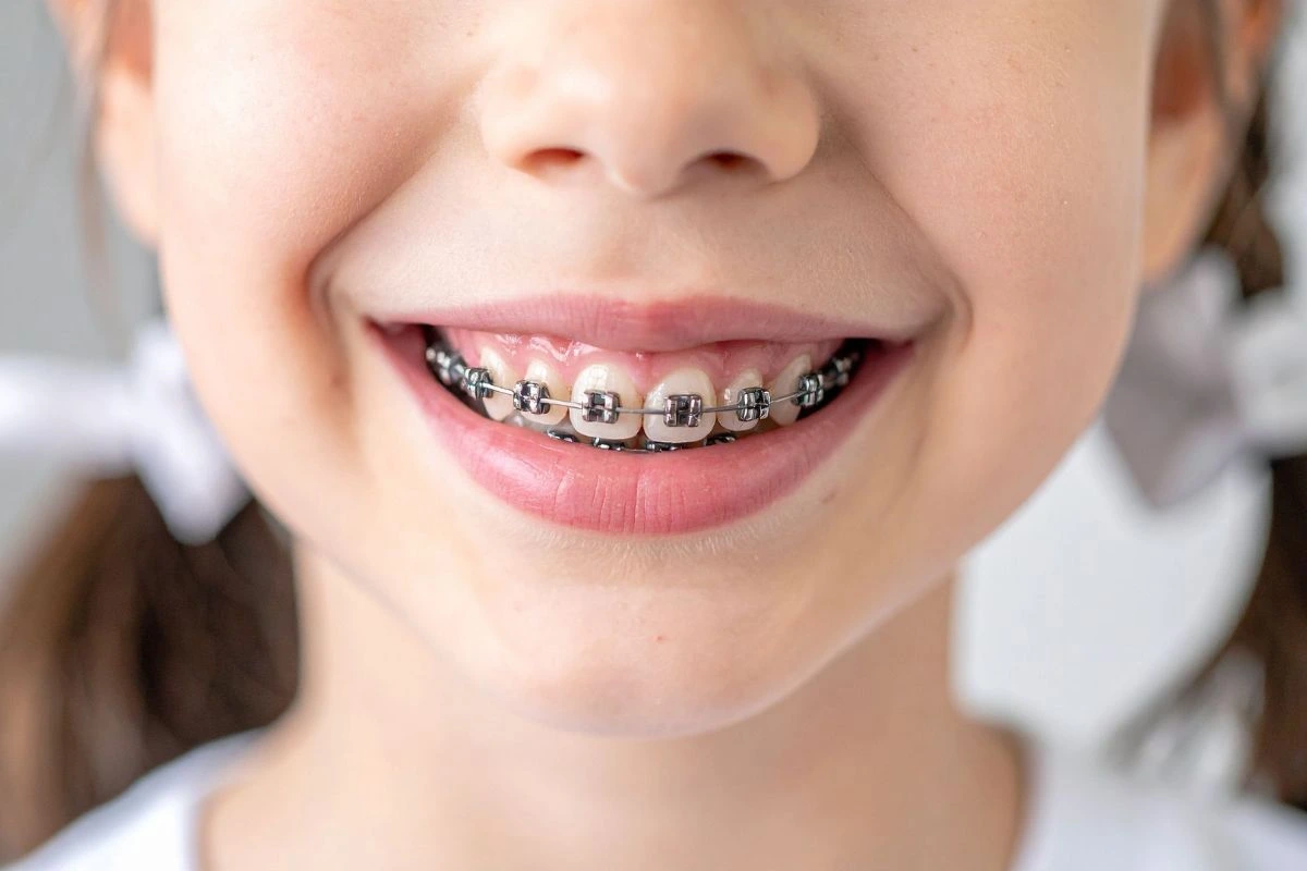 How to Handle Braces at School