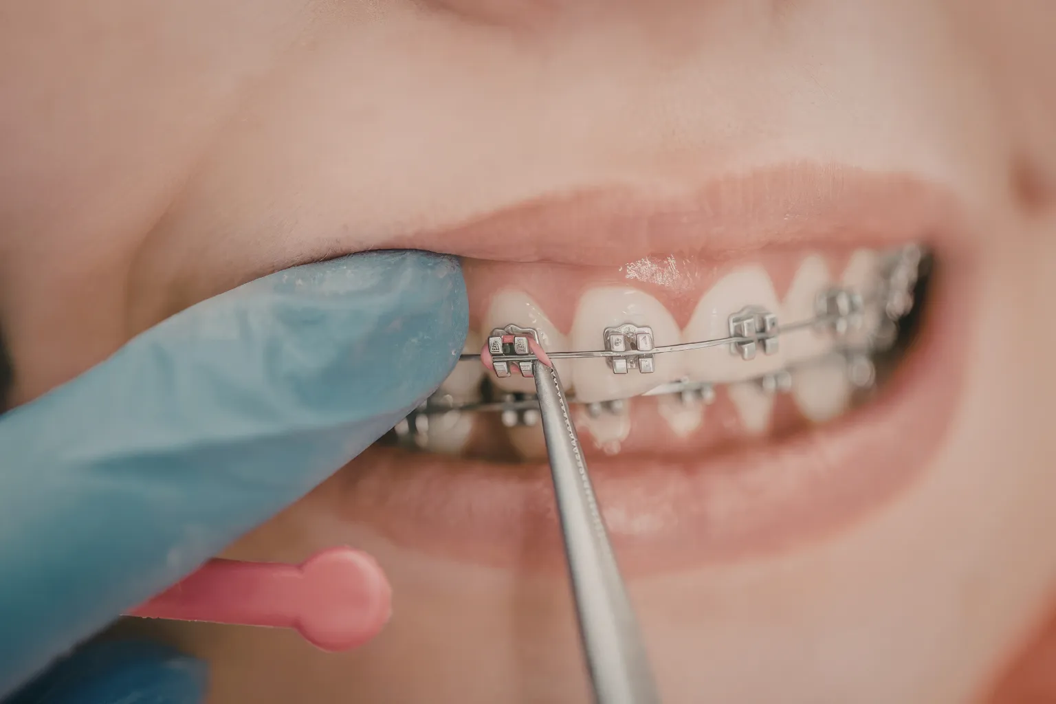 broken-braces-bracket-delay-treatment-time