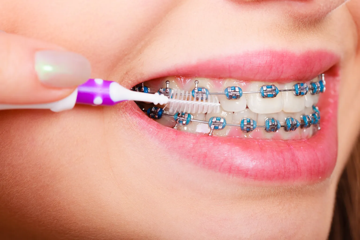 brushing-around-clear-ceramic-braces-brackets