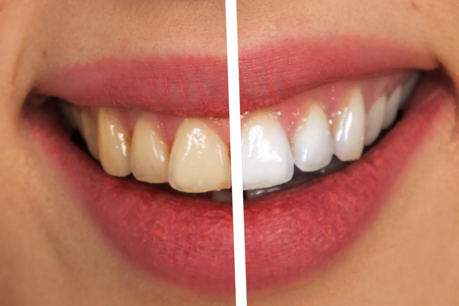 clear-aligners-for-bite-correction-diagram
