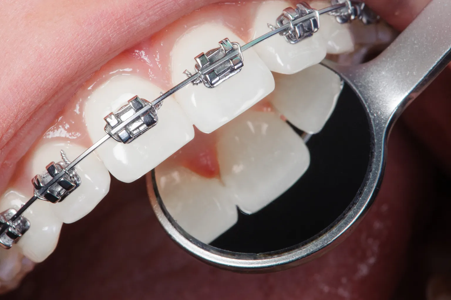 clear-ceramic-braces-discolored-vs-clean-elastic-ties