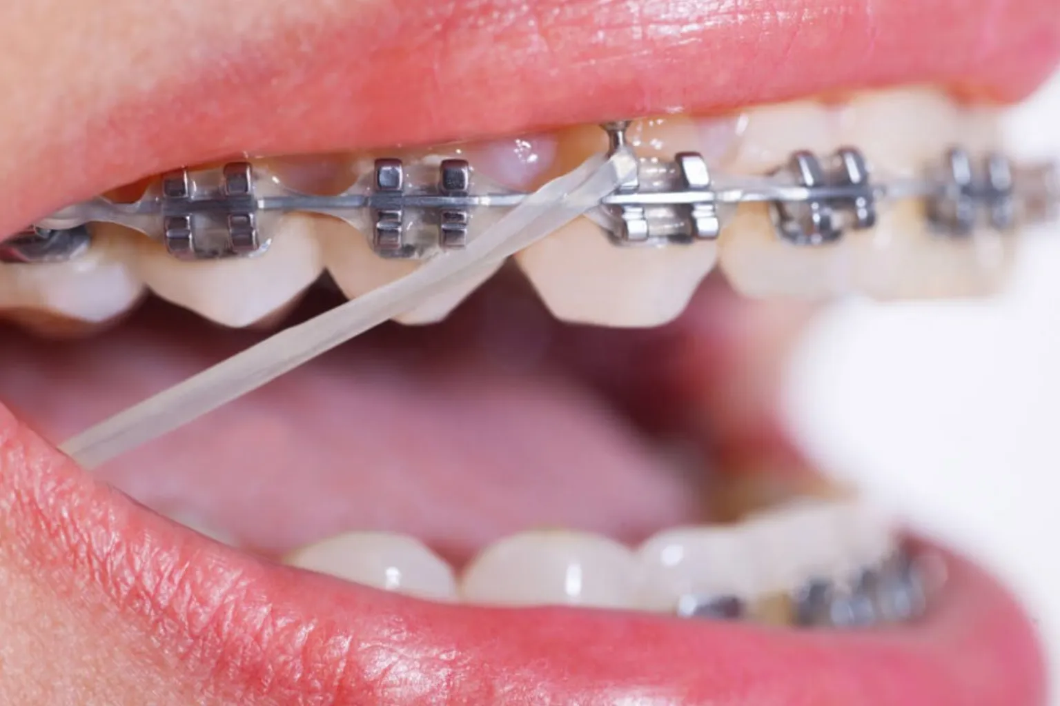 factors-affecting-braces-treatment-time-elastics