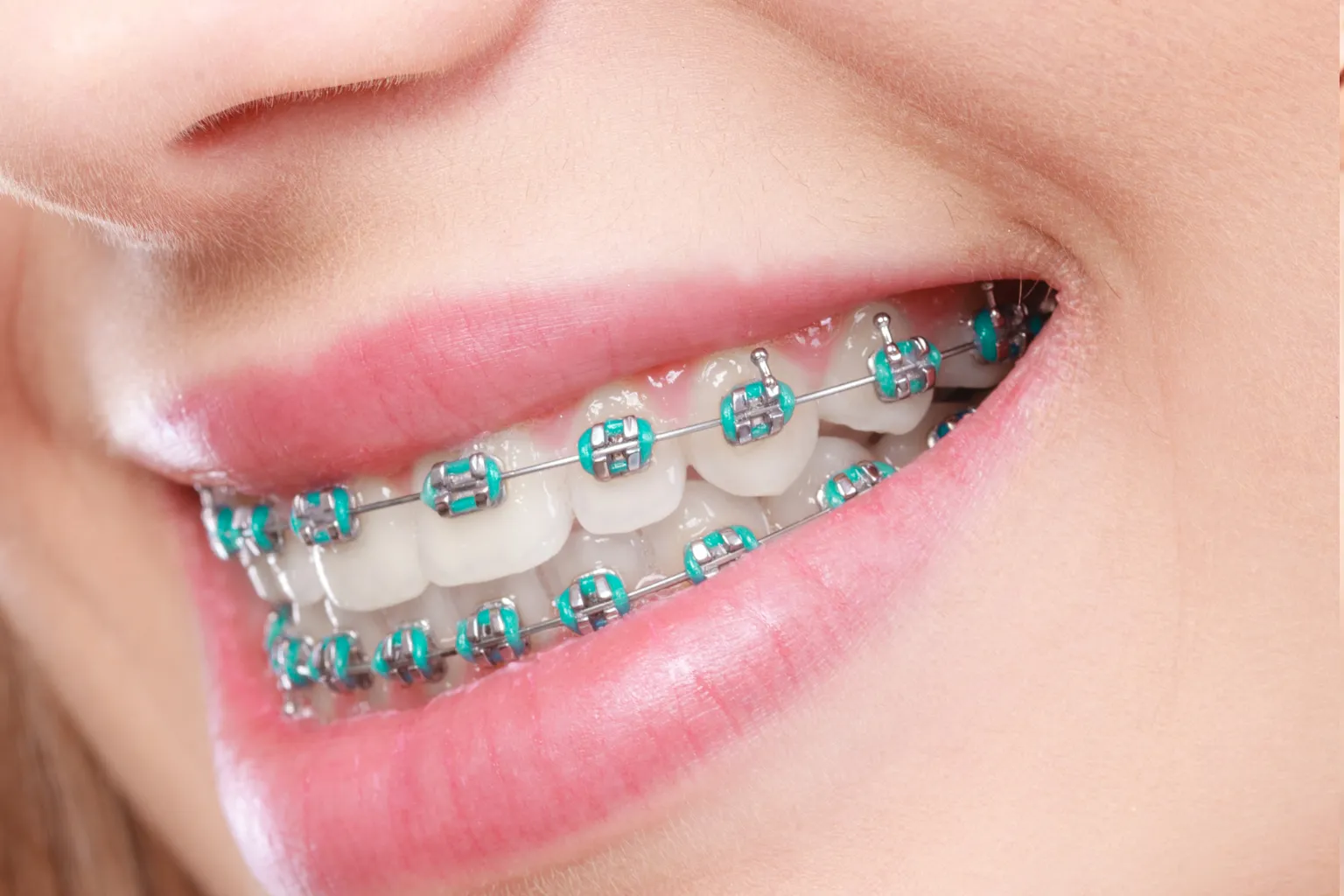 hard-and-sticky-foods-to-avoid-with-braces