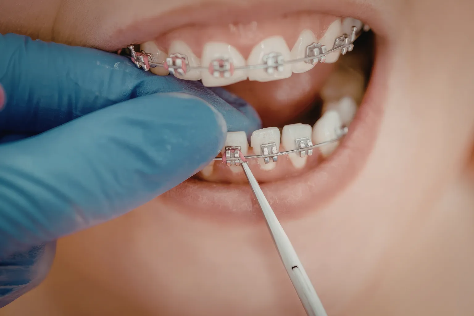 how-to-apply-orthodontic-wax-poking-wire