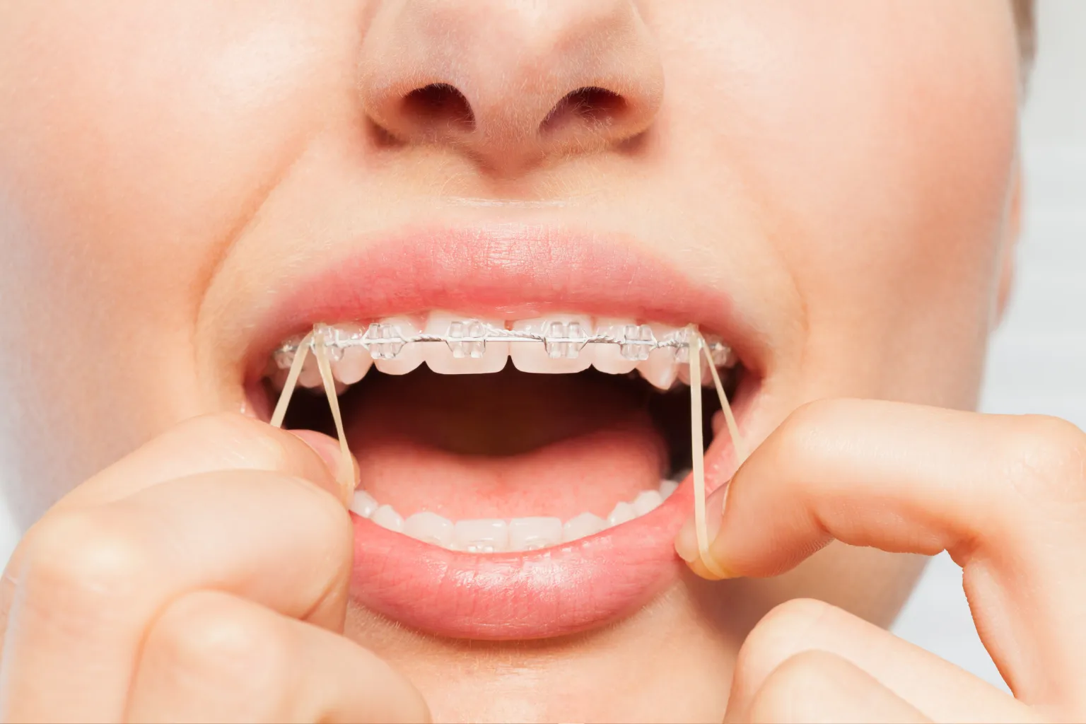 invisalign-attachments-and-elastics-for-underbite