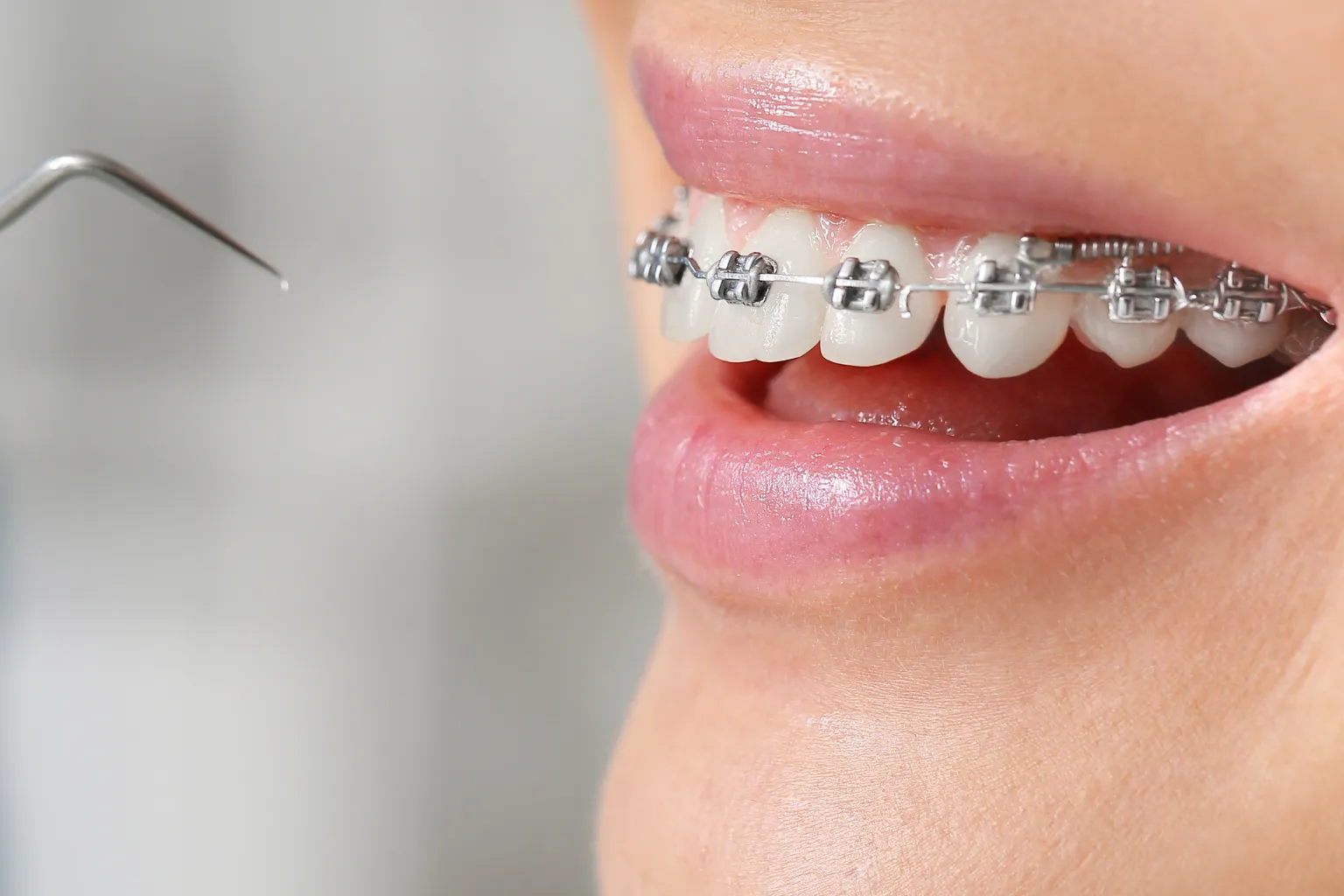 loose-braces-bracket-slipped-on-archwire