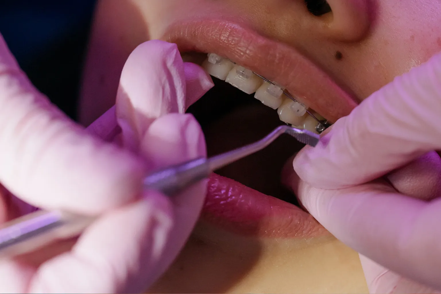 orthodontist-adjusting-braces-wire-saskatoon