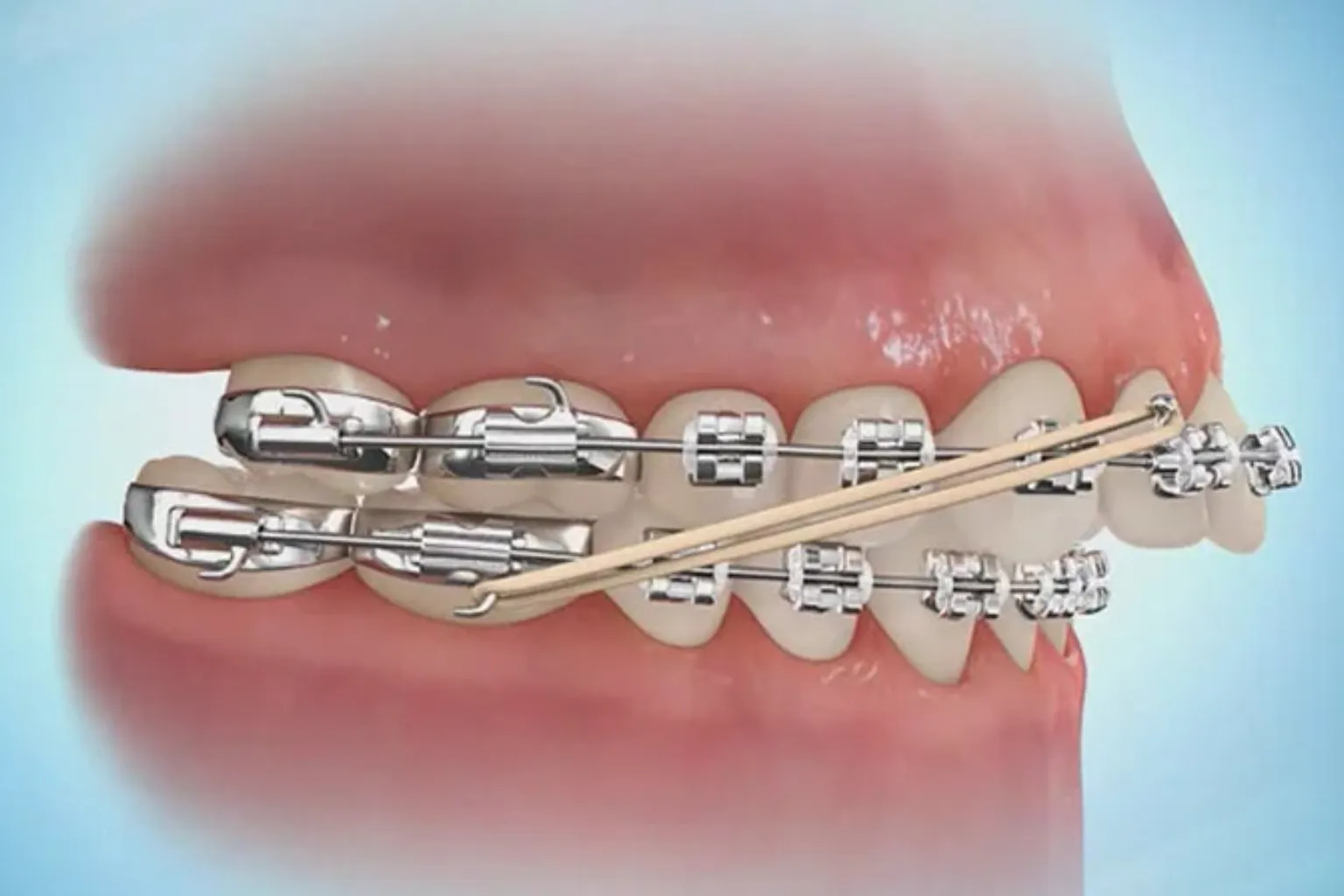 orthodontist-changing-clear-braces-elastic-ties-saskatoon