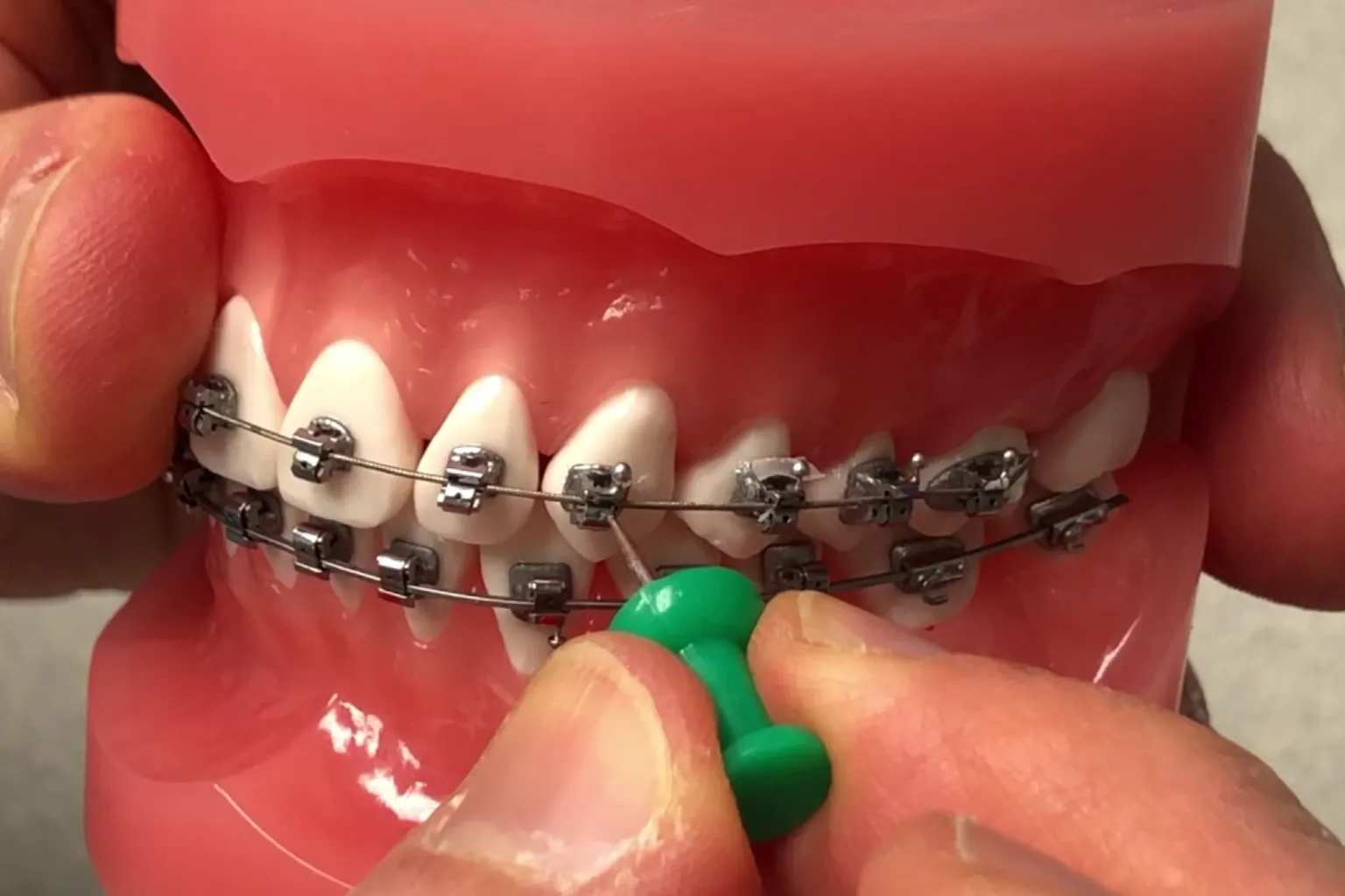 orthodontist-fixing-broken-bracket-wire-saskatoon