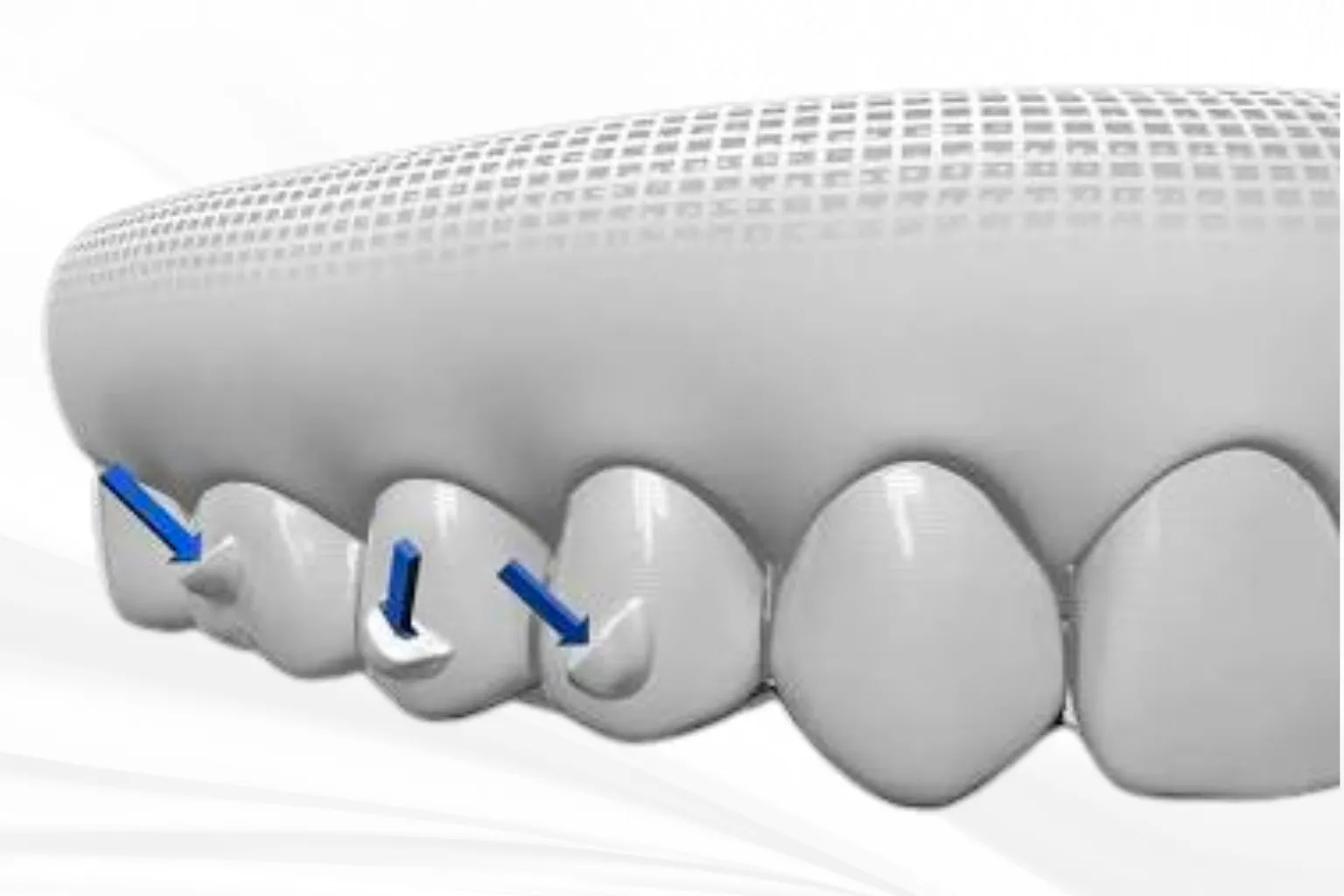 orthodontist-removing-invisalign-attachments